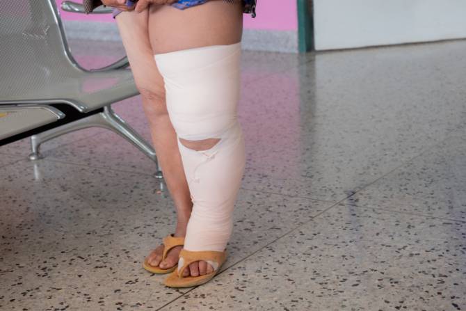 Edema arti inferiori